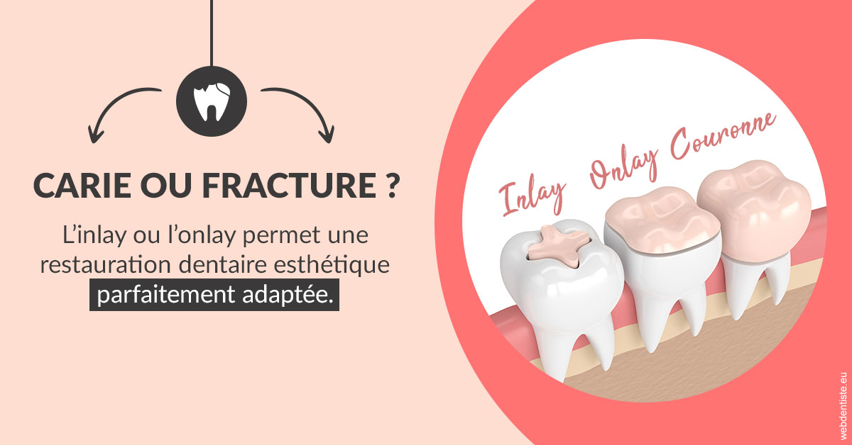 https://www.dentistesmerignac.fr/T2 2023 - Carie ou fracture 2