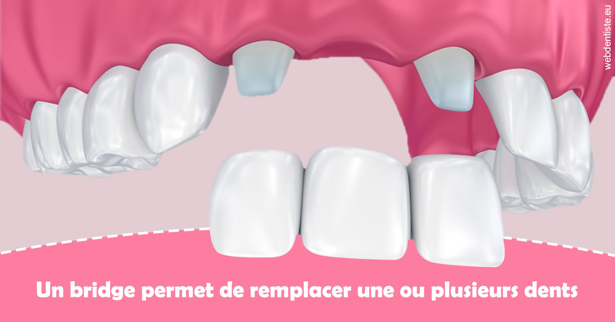 https://www.dentistesmerignac.fr/Bridge remplacer dents 2
