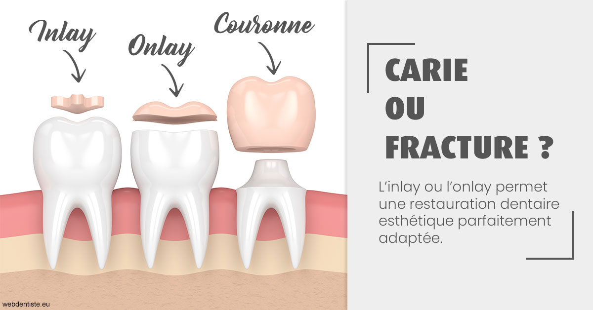 https://www.dentistesmerignac.fr/T2 2023 - Carie ou fracture 1