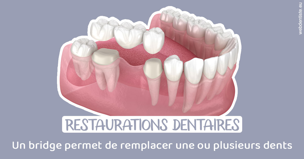 https://www.dentistesmerignac.fr/Bridge remplacer dents 1