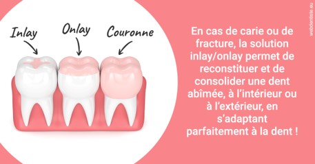 https://www.dentistesmerignac.fr/L'INLAY ou l'ONLAY 2