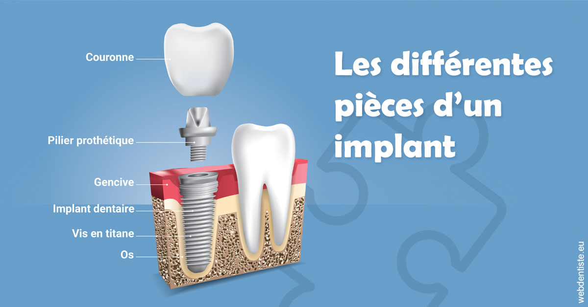 https://www.dentistesmerignac.fr/Les différentes pièces d’un implant 1